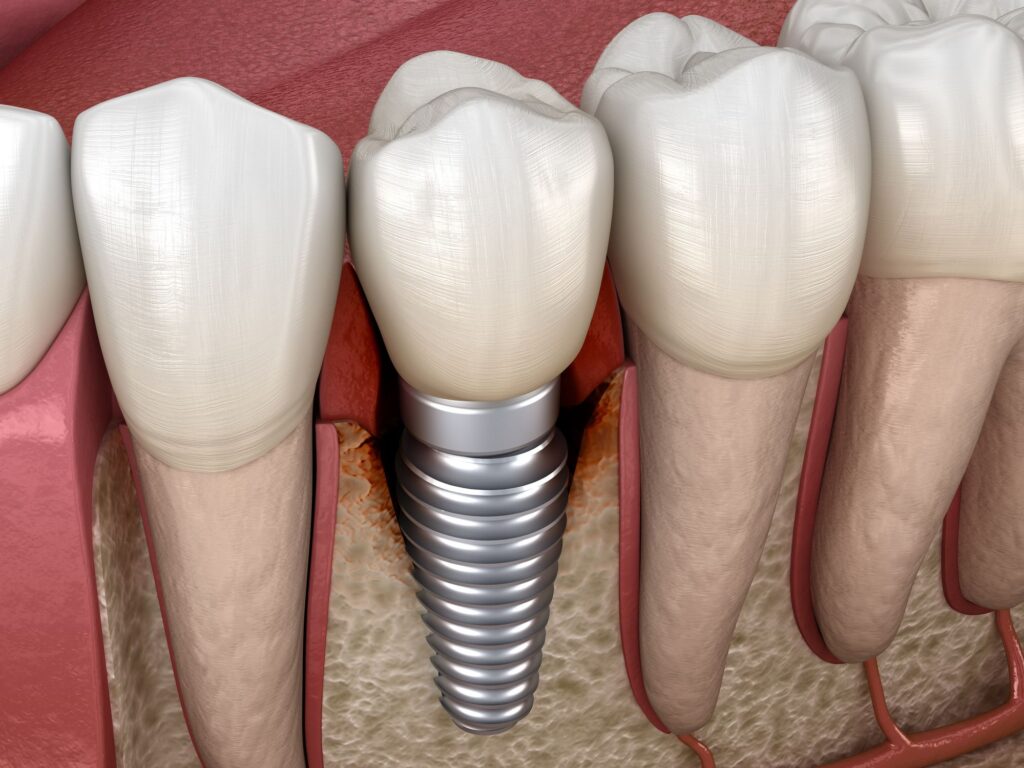 periimplantitis