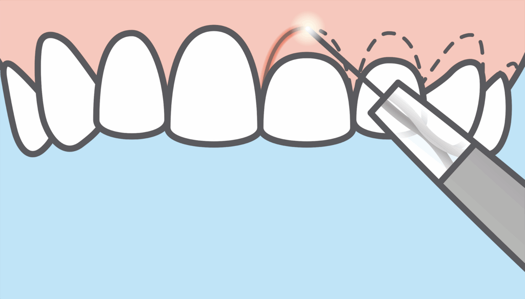 alargamiento coronario