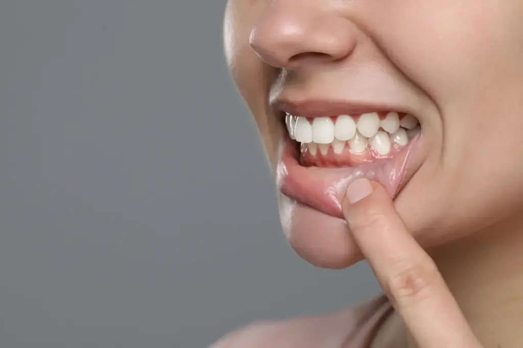 Enfermedades periodontales